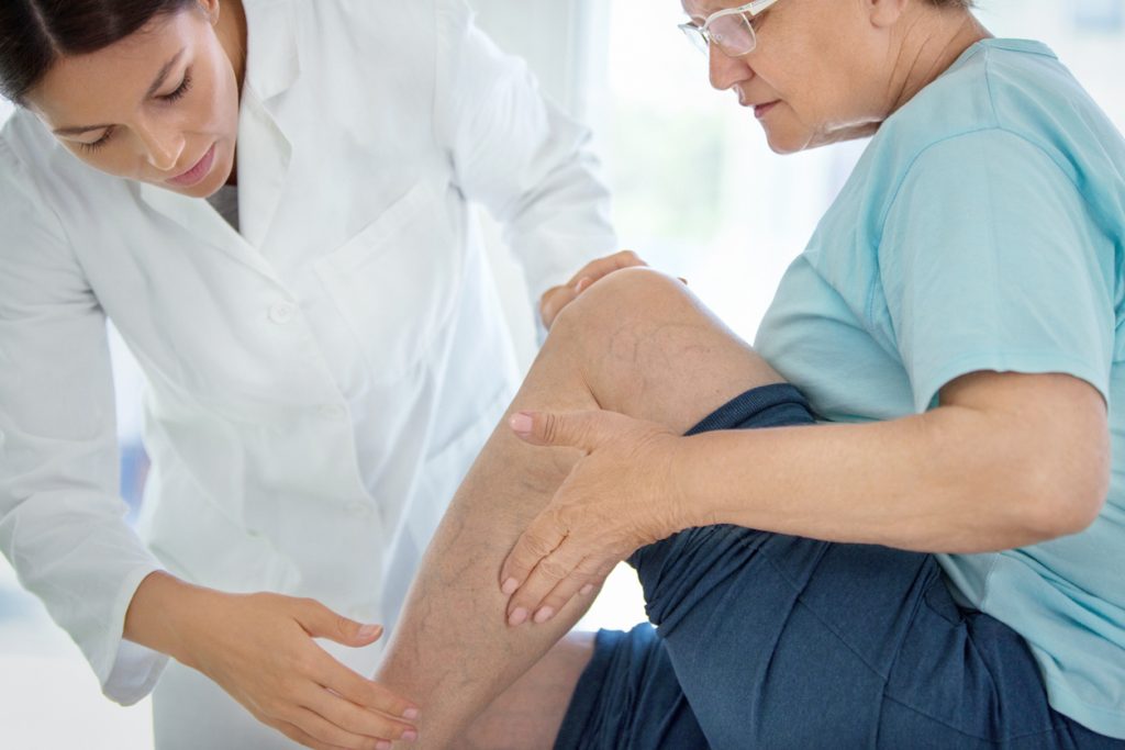 Can You Be Too Old for Varicose Vein Treatment? - Vein & Vascular