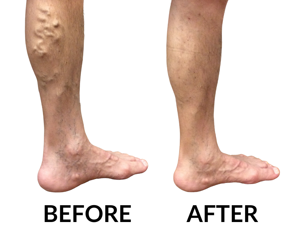 How to Prevent Varicose Veins From Getting Worse  Vein Center in Walnut  Creek, Brentwood, and Oakland