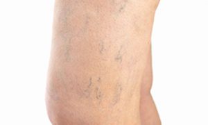 Skin Changes In Venous Insufficiency - Laurel Clinical